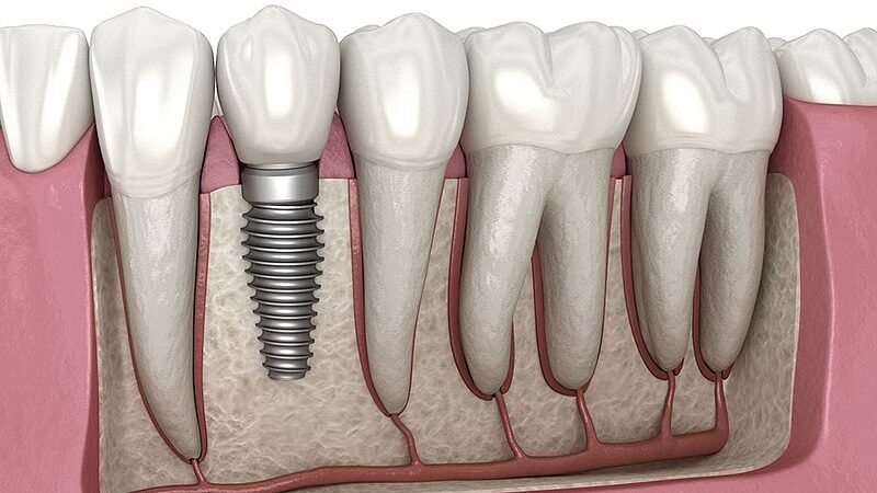 Important Questions to Ask Your Dentist about Dental Implants