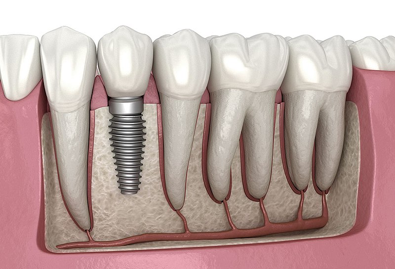 Important Questions to Ask Your Dentist about Dental Implants