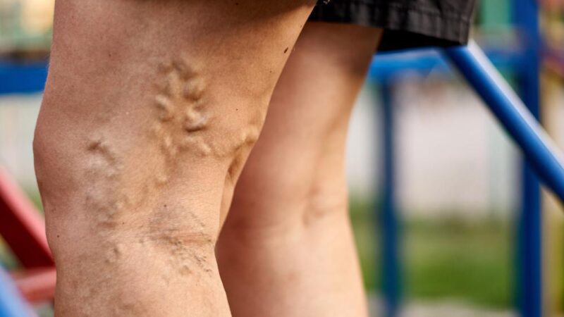 Dazzling Varicose Vein Treatments You Can Seek
