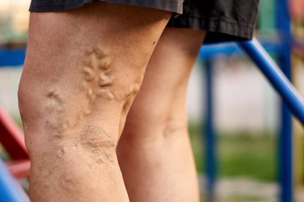 Dazzling Varicose Vein Treatments You Can Seek