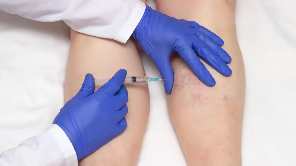 Why Settle for Sclerotherapy?