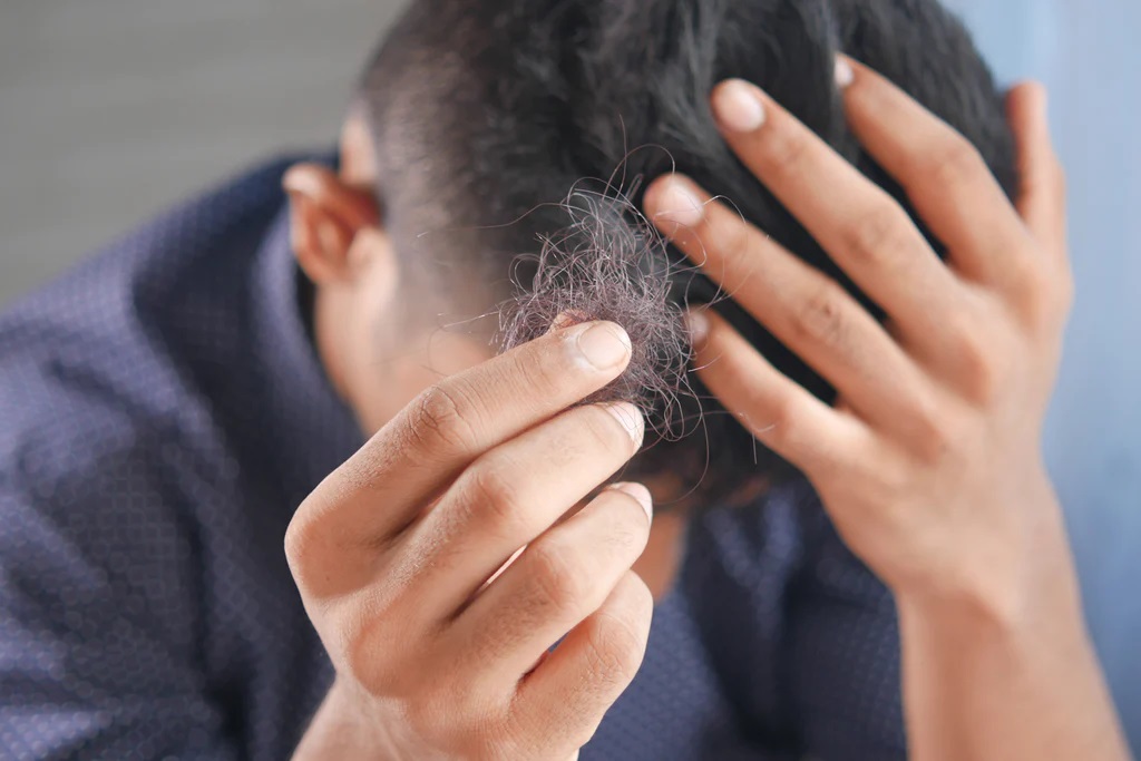 What is the Most Effective Hair Fall Treatment in Singapore?