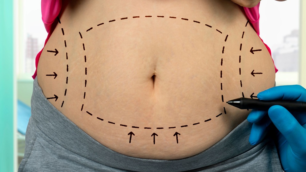 Everything You Need to Know About Liposuction