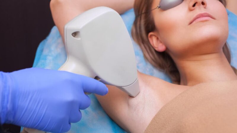 5 Things to Consider Before Having Laser Hair Removal