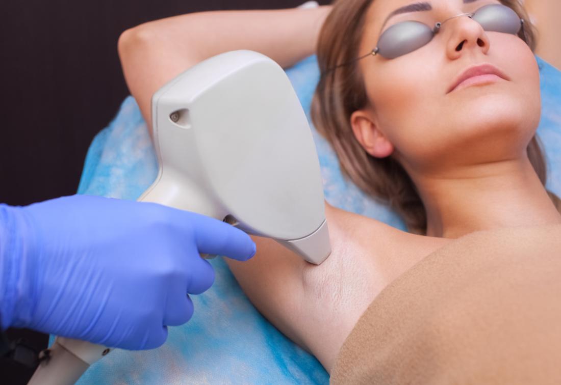 5 Things to Consider Before Having Laser Hair Removal