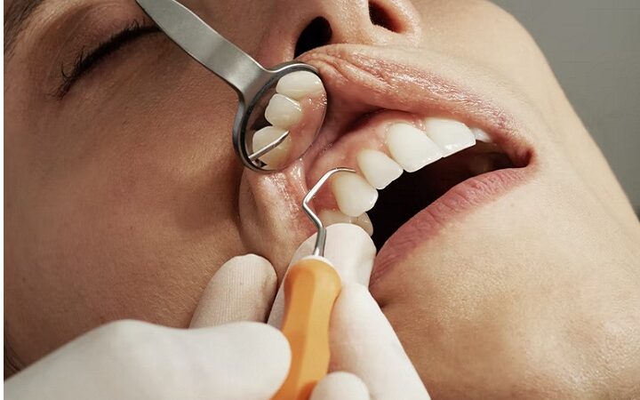 All You Should know About Root Canal Treatment