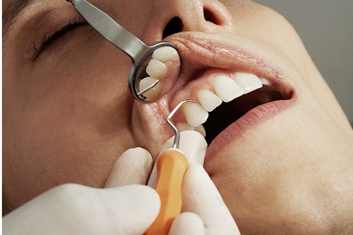 All You Should know About Root Canal Treatment