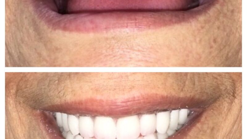 Restore Your Smile Aesthetics With Dentures