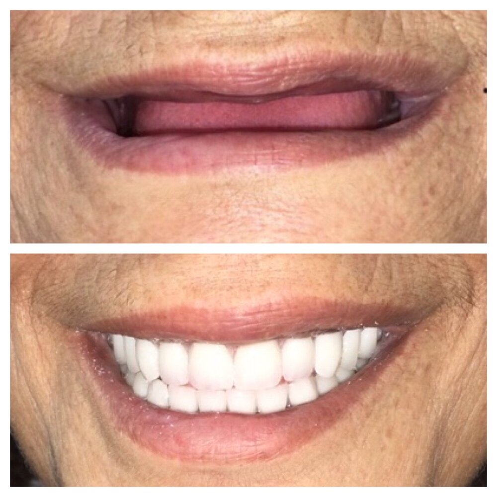 Restore Your Smile Aesthetics With Dentures