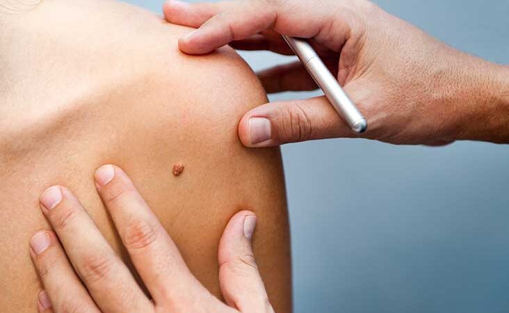 Signs That Your Mole Is Cancerous