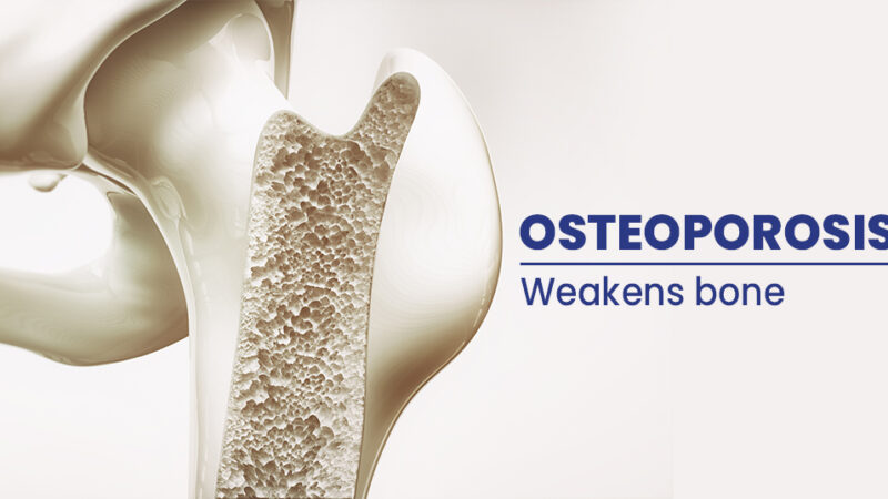 Risks Factors and Treatments for Osteoporosis