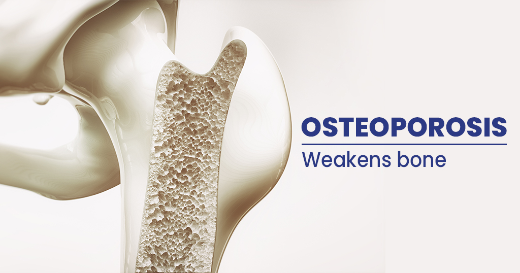 Risks Factors and Treatments for Osteoporosis