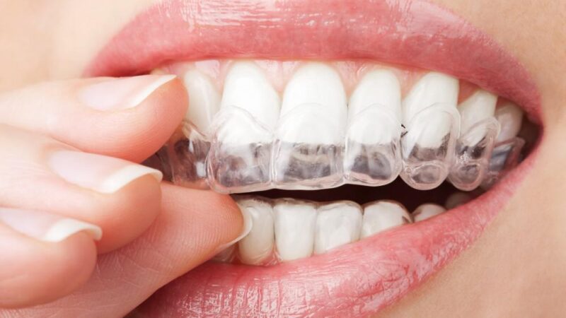 Tips To Maintain Your Invisalign Aligners 