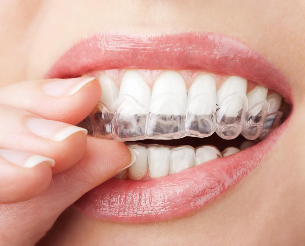 Tips To Maintain Your Invisalign Aligners 