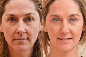 Laser Resurfacing for Better Skin