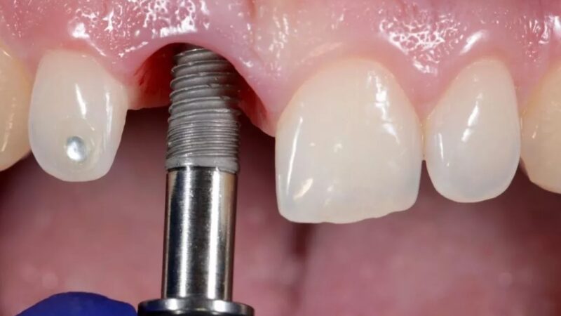 How to Prepare for a Dental Implant Procedure