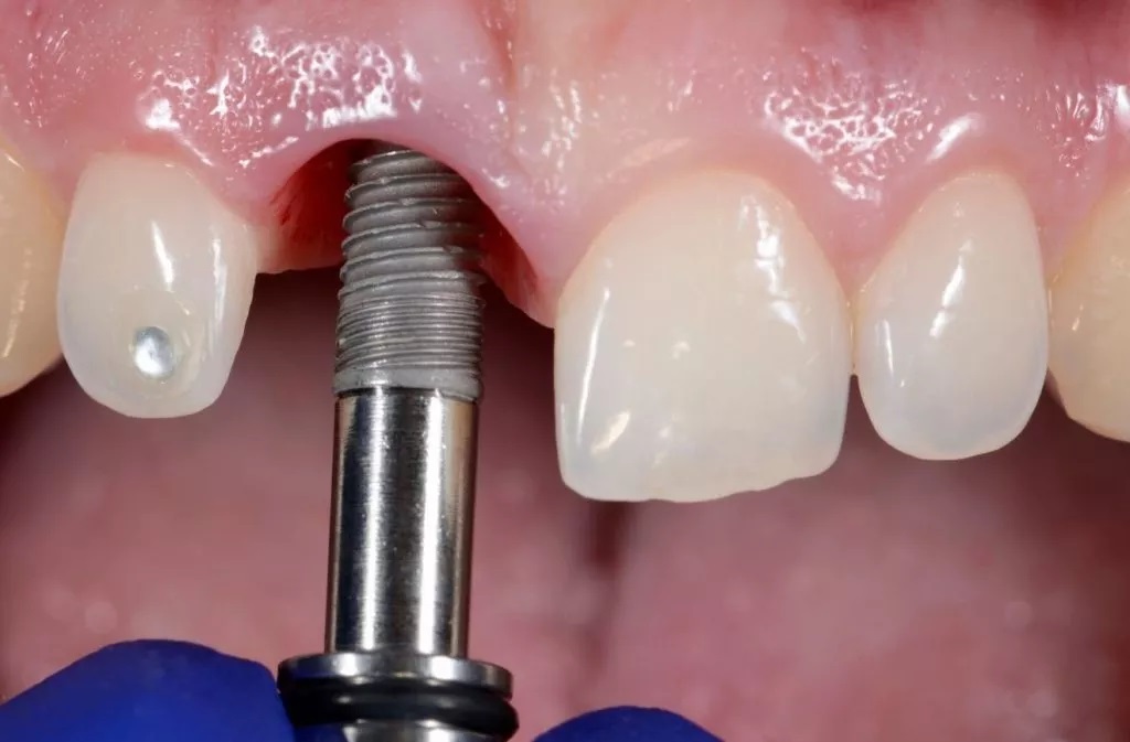 How to Prepare for a Dental Implant Procedure