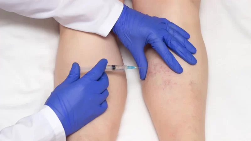 Reviewing the pros and cons of Sclerotherapy