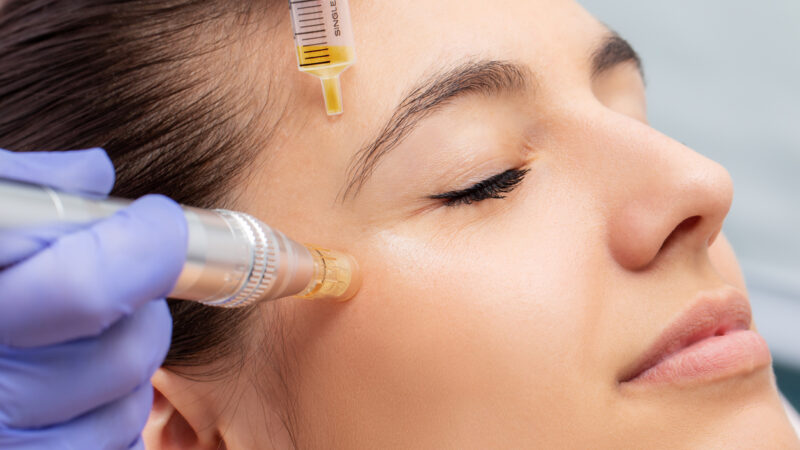 Amazing Benefits of PRP Facials You Need to Know About