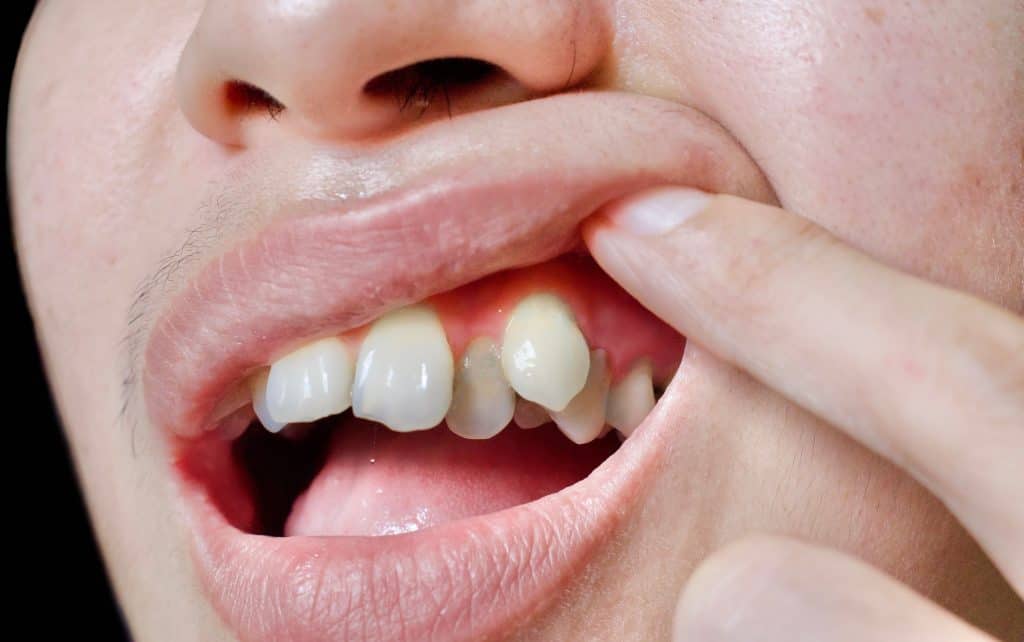 Why Retainers Might Be the Best Solution for Your Misaligned Teeth