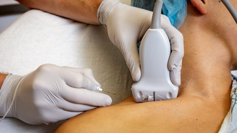 Exploring The Benefits and Risks of Nerve Blocks
