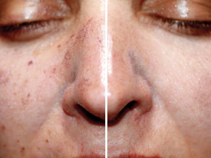 Pico Laser Review: Real Results and Benefits of This Non-Surgical Treatment