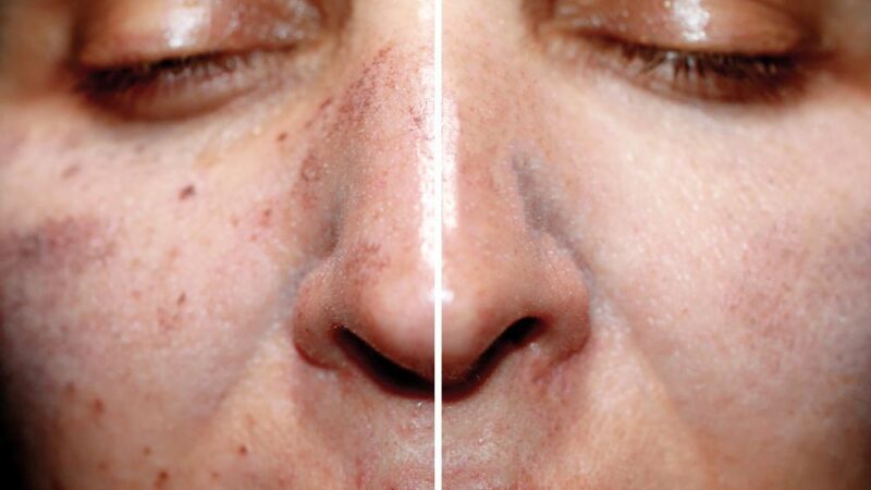 Pico Laser Review: Real Results and Benefits of This Non-Surgical Treatment