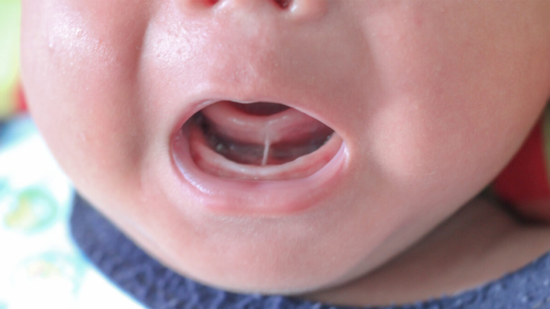 What You Should Know About Tongue-Tie Syndrome