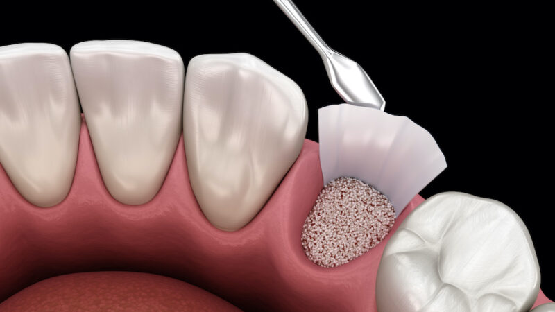 What is the Procedure for Dental Bone Grafting? 