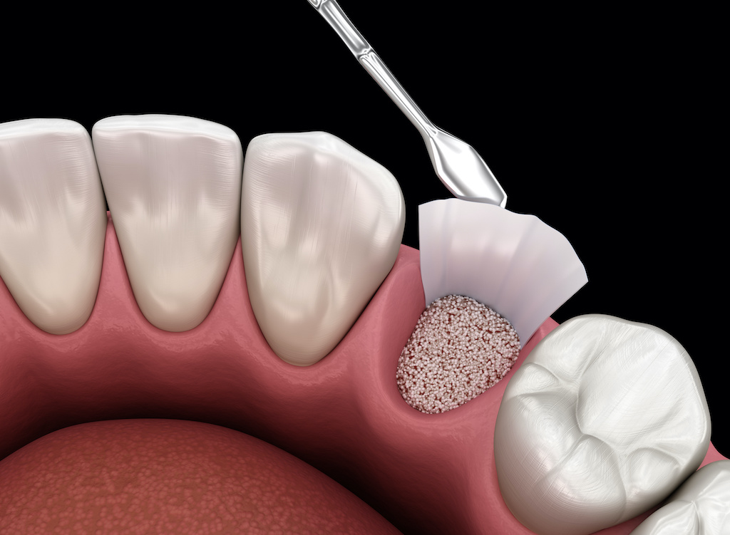 What is the Procedure for Dental Bone Grafting? 