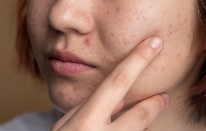 Understanding What Causes Acne in Adults?