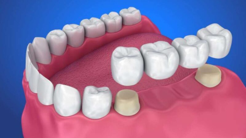 Best Maintenance Tips for Your Crowns and Bridges