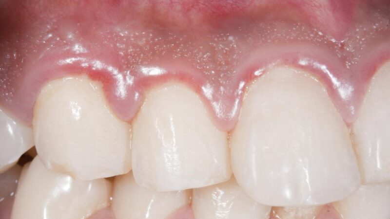 What are the Causes of Gum Disease, and What is the Best Treatment?