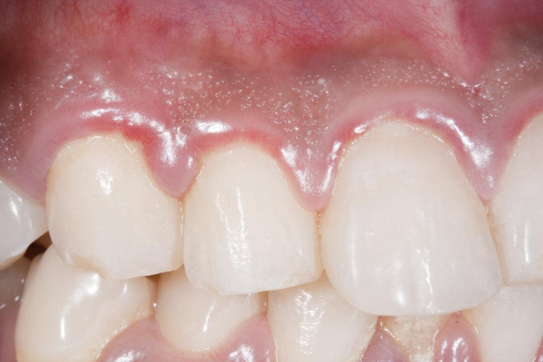 What are the Causes of Gum Disease, and What is the Best Treatment?