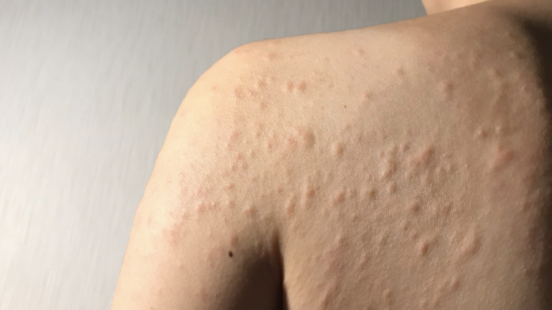 How to keep skin allergies in control?