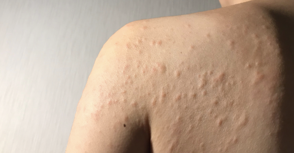 How to keep skin allergies in control?