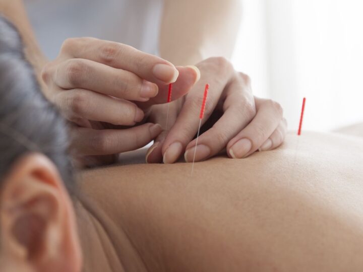 Dry Needling: A Deep Dive into a Modern Healing Technique