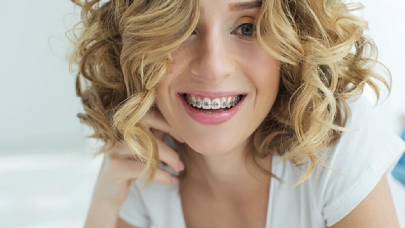 Why are clear braces becoming so common in Clapham?
