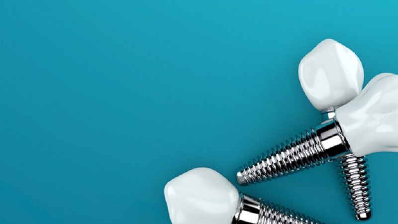 Getting dental implants in Navan