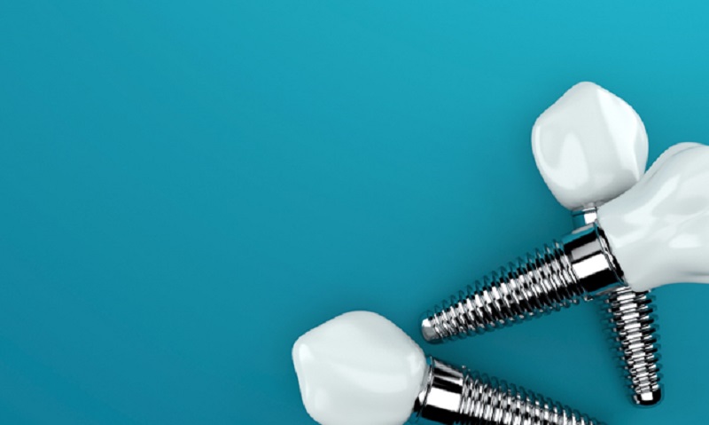 Getting dental implants in Navan