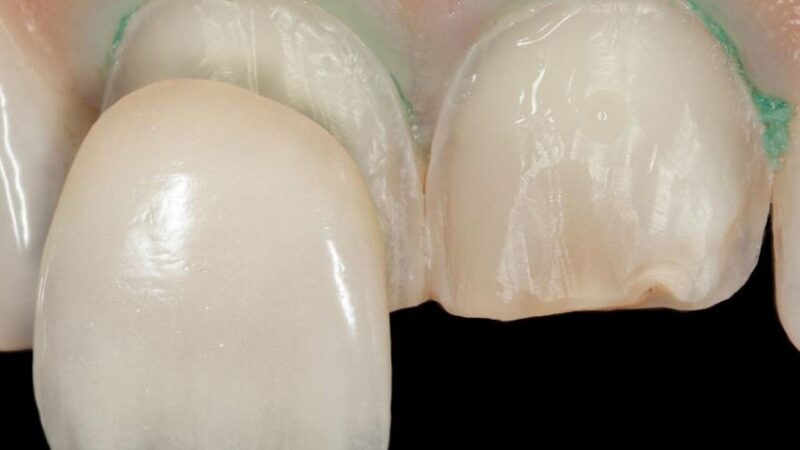 Choosing the Most Suitable Color for Dental Veneers