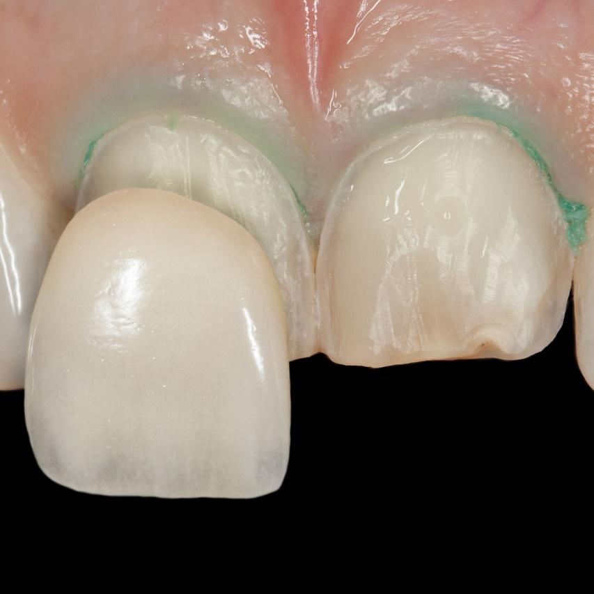 Choosing the Most Suitable Color for Dental Veneers