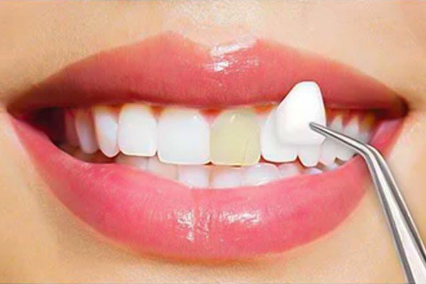 Revitalize Your Smile: The Wonders of Porcelain Veneers