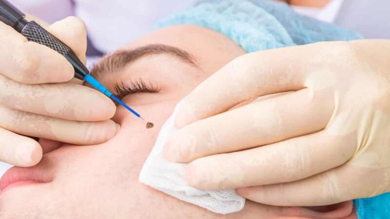 Mastering Wart Removal: Insights, Solutions, and Pricing Demystified