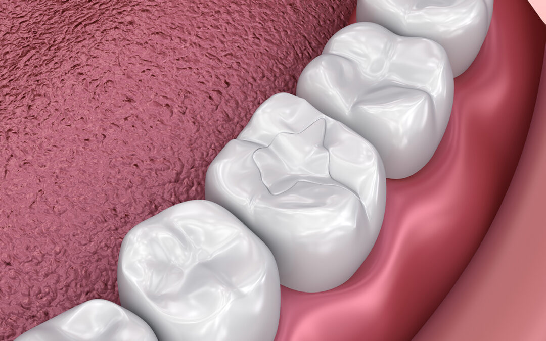 Six Reasons to Replace a Missing Tooth in Hollywood, FL: Preserving Your Smile and Oral Functioning
