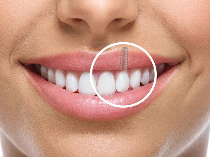 Stronger Than Ever: The Jaw-Dropping Health Benefits of Dental Implants You Didn’t Know