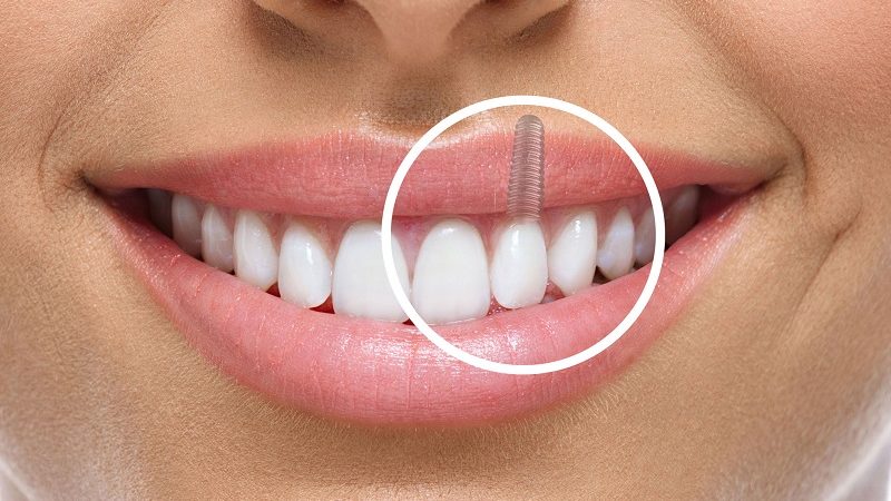 Stronger Than Ever: The Jaw-Dropping Health Benefits of Dental Implants You Didn’t Know