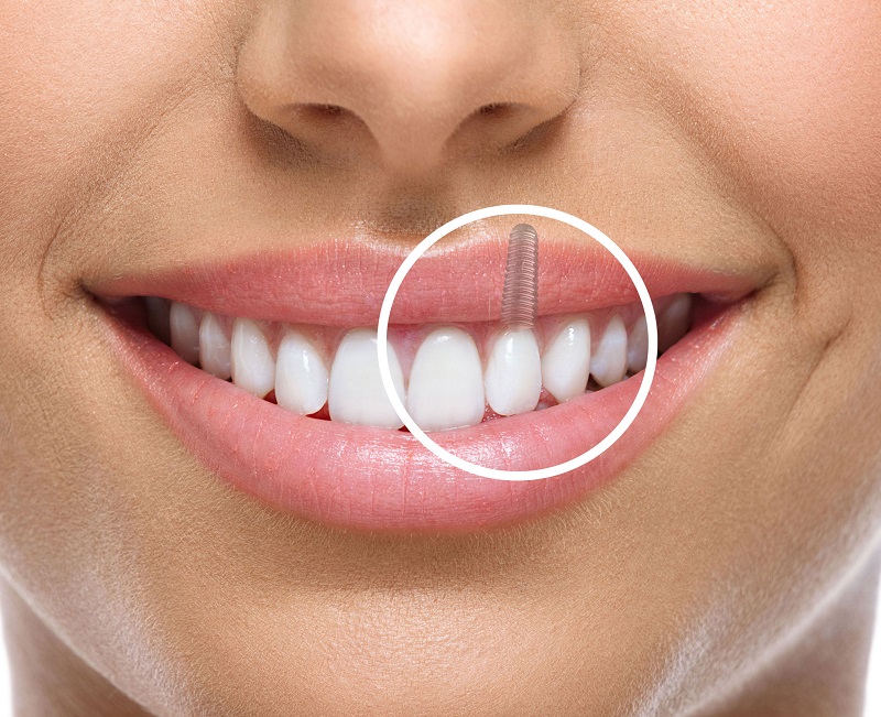 Stronger Than Ever: The Jaw-Dropping Health Benefits of Dental Implants You Didn’t Know