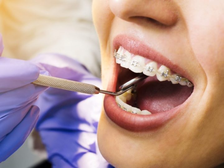 A Comprehensive Guide to the Stages of Orthodontic Treatment