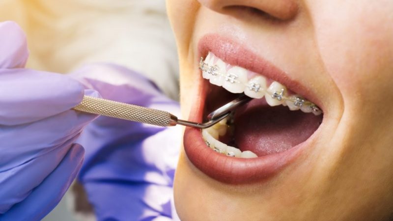 A Comprehensive Guide to the Stages of Orthodontic Treatment